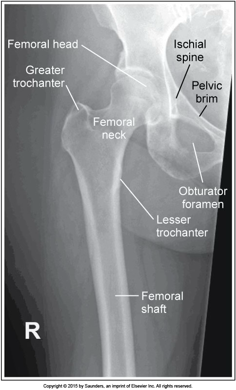 <p>AP femur</p>