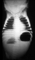 <p>portion of the duodenum is completely or partially absent or closed, preventing the normal passage of stomach contents into the small intestine.</p><p>-Obstruction causes a blockage that can lead to vomiting shortly after birth</p><p>-Occurs in 1:10K live births</p><p>-30% associated with congenital chromosomal disorder-- Downs common</p><p>SXS</p><p>-bilious or non-bilious vomiting, </p><p>-abdominal distentio</p><p>-inability to tolerate food.</p><p>Radiology finding: "double bubble sign"</p><p>--> Represents a distended stomach and duodenum</p>