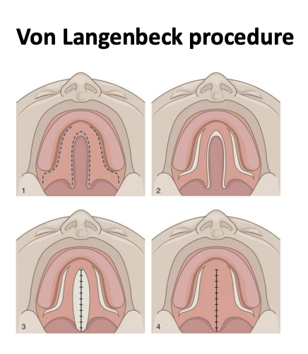 <p>Surgery to repair cleft palate by raising two bipedicled (attached at two ends) flaps of mucoperiosteum and bringing them together and attaching them to close the cleft.</p>