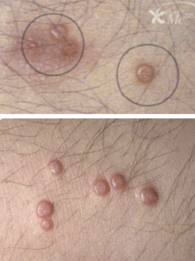 <p>⚠️‼️15.Identify the lesion: A.Molluscum contagiosum B.Lymphogranuloma venereum C.Granuloma inguinale D.Condyloma acuminata</p>