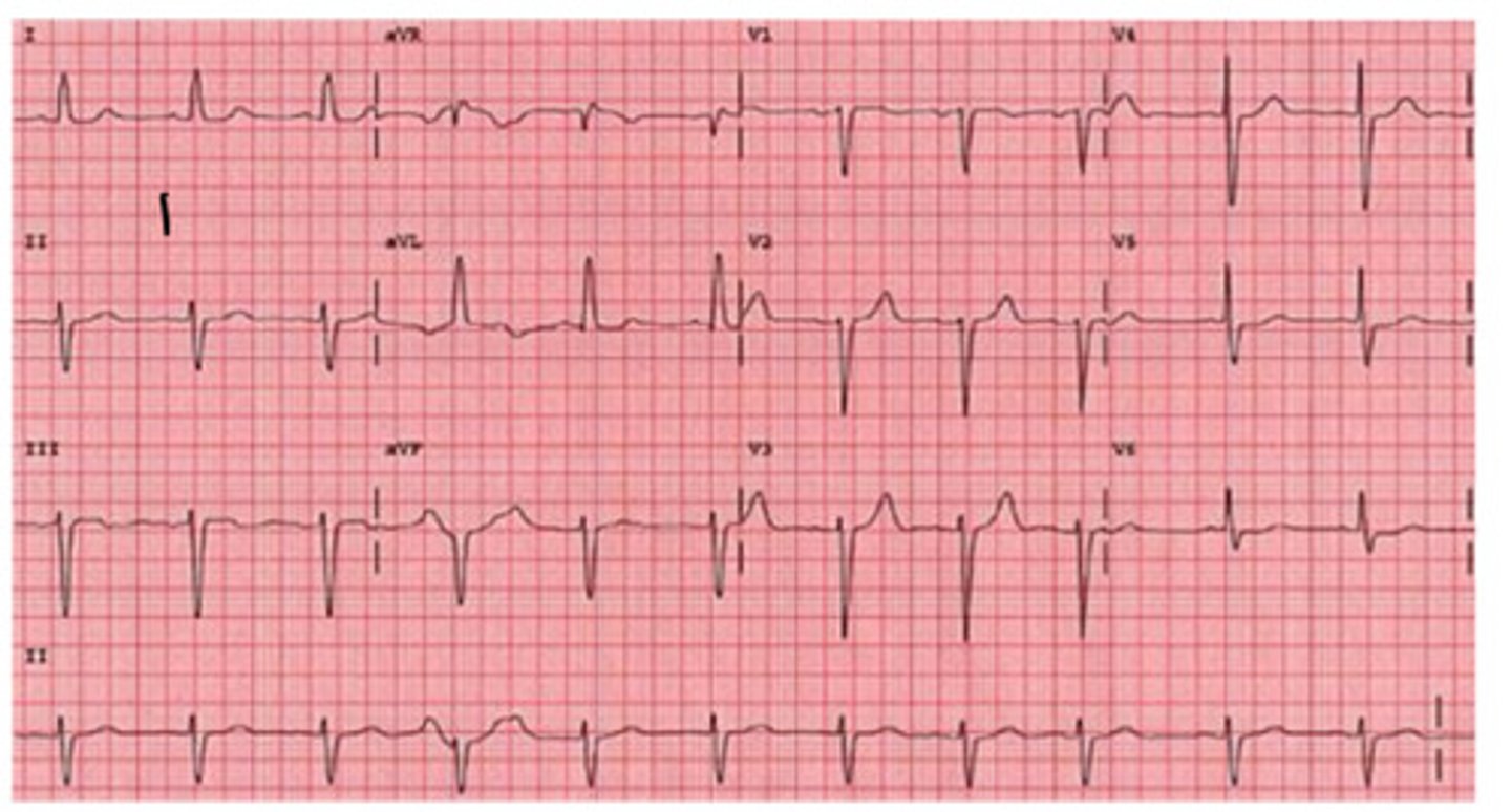 <p>is this normal, left, or right axis deviation? why</p>