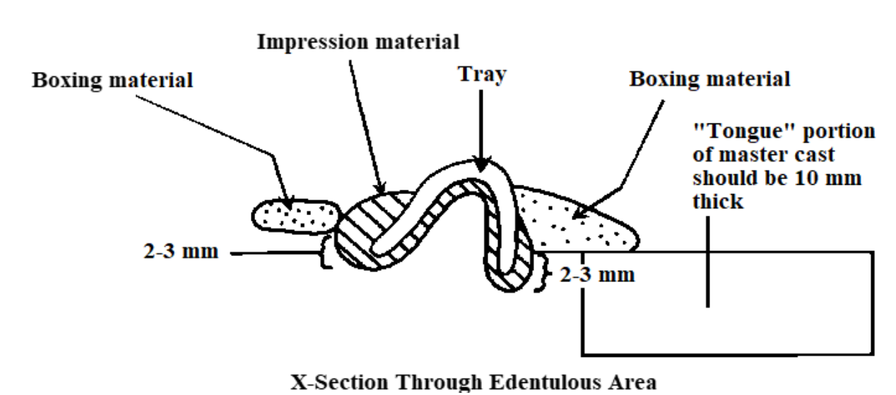 <p>After adding on the new (altered) cast distal extension, attach the framework to the cast and box everything up with caulking and tape. What material do you use to pour up?</p>