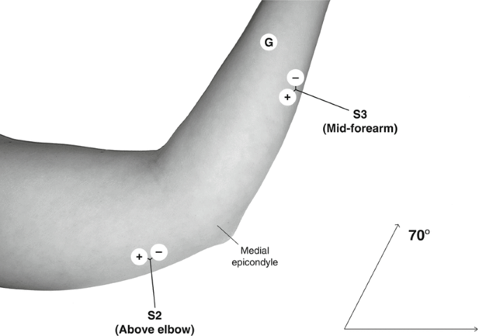 <p>1. mid forearm (PPD testing)</p><p></p><p>2. back (allergy testing)</p><p></p><table style="min-width: 100px;"><colgroup><col style="min-width: 25px;"><col style="min-width: 25px;"><col style="min-width: 25px;"><col style="min-width: 25px;"></colgroup><tbody><tr><td colspan="1" rowspan="1" style="border: 1px solid rgb(196, 199, 197); padding: 8px 12px;"><p><strong>type</strong></p></td><td colspan="1" rowspan="1" style="border: 1px solid rgb(196, 199, 197); padding: 8px 12px;"><p><strong>Needle Gauge & Length</strong></p></td><td colspan="1" rowspan="1" style="border: 1px solid rgb(196, 199, 197); padding: 8px 12px;"><p><strong>Angle</strong></p></td><td colspan="1" rowspan="1" style="border: 1px solid rgb(196, 199, 197); padding: 8px 12px;"><p><strong>Location</strong></p></td></tr><tr><td colspan="1" rowspan="1" style="border: 1px solid rgb(196, 199, 197); padding: 8px 12px;"><p><span><strong>Intramuscular (IM)</strong></span></p></td><td colspan="1" rowspan="1" style="border: 1px solid rgb(196, 199, 197); padding: 8px 12px;"><p><span>20-23 G x 1-3"</span></p></td><td colspan="1" rowspan="1" style="border: 1px solid rgb(196, 199, 197); padding: 8px 12px;"><p><span>90°</span></p></td><td colspan="1" rowspan="1" style="border: 1px solid rgb(196, 199, 197); padding: 8px 12px;"><p>1. deltoid ≤ 1 mL</p><p><br></p><p>2. ventrogluteal > 1 mL</p><p><br></p><p>3. vastus lateralis (pediatrics)</p></td></tr><tr><td colspan="1" rowspan="1" style="border: 1px solid rgb(196, 199, 197); padding: 8px 12px;"><p><span><strong>Subcutaneous (SC)</strong></span></p></td><td colspan="1" rowspan="1" style="border: 1px solid rgb(196, 199, 197); padding: 8px 12px;"><p><span>25-26 G x 5/8"</span></p></td><td colspan="1" rowspan="1" style="border: 1px solid rgb(196, 199, 197); padding: 8px 12px;"><p><span>45°</span></p></td><td colspan="1" rowspan="1" style="border: 1px solid rgb(196, 199, 197); padding: 8px 12px;"><p>1. lower abdomen</p><p><br></p><p>2. fatty part of upper arm</p><p><br></p><p>3. outer thigh</p></td></tr><tr><td colspan="1" rowspan="1" style="border: 1px solid rgb(196, 199, 197); padding: 8px 12px;"><p><span><strong>Insulin (SC)</strong></span></p></td><td colspan="1" rowspan="1" style="border: 1px solid rgb(196, 199, 197); padding: 8px 12px;"><p><span>31 G x 1/4"</span></p></td><td colspan="1" rowspan="1" style="border: 1px solid rgb(196, 199, 197); padding: 8px 12px;"><p><span>90°</span></p></td><td colspan="1" rowspan="1" style="border: 1px solid rgb(196, 199, 197); padding: 8px 12px;"><p><span><em>(Locations shared with Subcutaneous above)</em></span></p></td></tr><tr><td colspan="1" rowspan="1" style="border: 1px solid rgb(196, 199, 197); padding: 8px 12px;"><p><span><strong>Intradermal (ID)</strong></span></p></td><td colspan="1" rowspan="1" style="border: 1px solid rgb(196, 199, 197); padding: 8px 12px;"><p><span>27-28 G x 3/8</span></p></td><td colspan="1" rowspan="1" style="border: 1px solid rgb(196, 199, 197); padding: 8px 12px;"><p><span>5-15°</span></p></td><td colspan="1" rowspan="1" style="border: 1px solid rgb(196, 199, 197); padding: 8px 12px;"><p>1. mid forearm (PPD testing)</p><p><br></p><p>2. back (allergy testing)</p></td></tr></tbody></table><p></p>