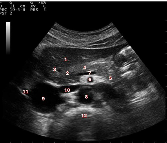 <p>What structure/vessel is indicated by #4?</p><p>a. body of pancreas</p><p>b. head of pancreas</p><p>c. left lobe of liver</p><p>d. tail of pancreas</p>