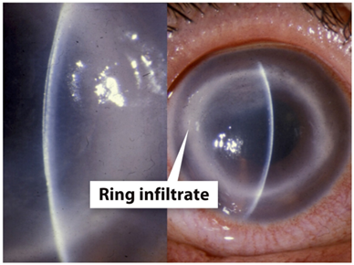 <p>Causative Agent: Acanthamoeba Species<br>Symptoms/Signs: Eyes red, painful, and teary; Patient will avoid light and suffer vision loss; Effects become permanent if untreated<br></p>