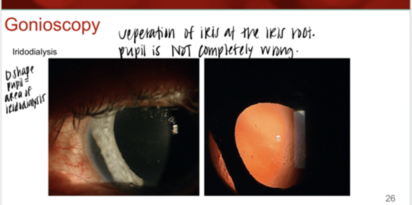 <p>Iridodialysis will result in a ____ shaped pupil</p>