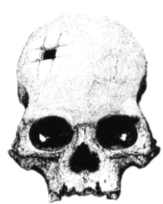 <p>An ancient surgery where a <strong>hole was made in the skull.</strong></p>