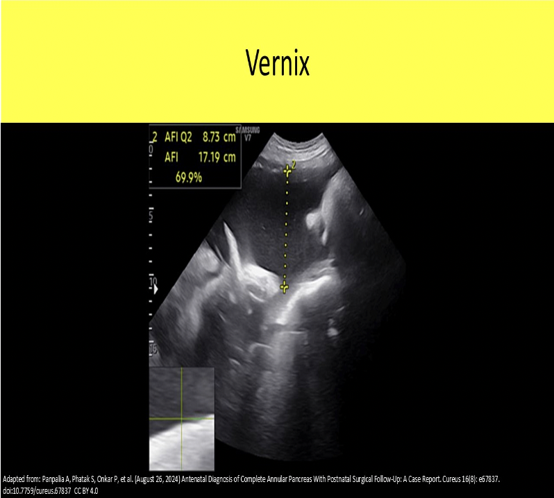 <p>A. vernix</p><p>Vernix refers to a normal finding of sebum and epithelial cells that cause white free-floating debris within the amniotic fluid late in pregnancy. Meconium refers to an abnormal finding of fetal waste, sebum and epithelial cells, that cause hypochoic free-floating debris within the amniotic fluid late in pregnancy. Normally meconium is visualized in the fetal colon in near term pregnancies. If the fetus has a bowel movement, it is a sign of fetal distress.</p>