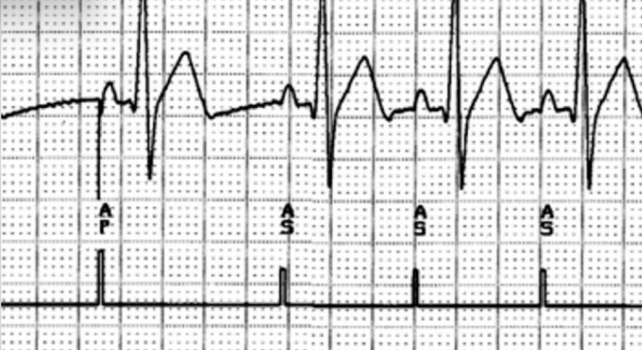 <p>atrial capture</p>