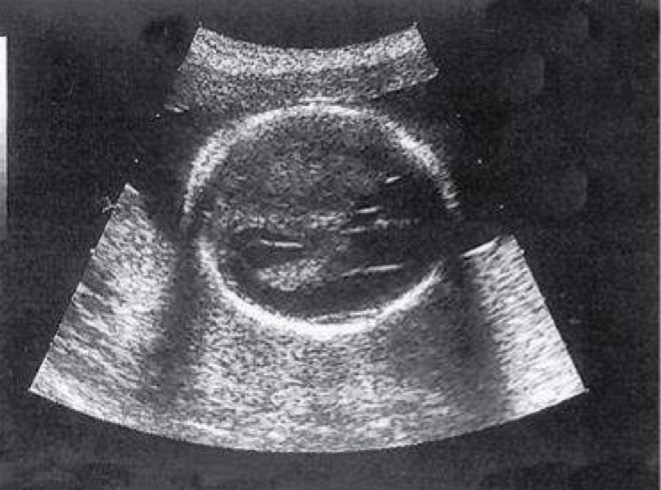<p>4 ventricles: 2 lateral ventricles (choroid plexus) and 3rd/4th ventricle; except for areas containing choroid plexus, ventricles are anechoic</p>