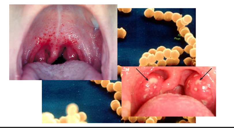 <p>Causes Strep Throat</p>
