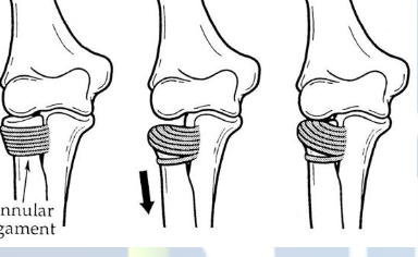 <p>Pulled elbow syndrome/nursemaid elbow</p>