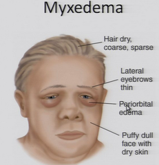 <p>what is the result of progressed hypothyroidism</p>