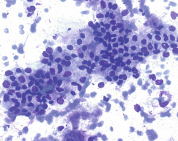 <p>Kyste du pancreas </p><p>1) diagnostic</p><p>2) morphologie </p><p>3) biochimie</p><p>4) altérations moléculaire</p><p>5) altérations moléculaire de haut risque</p><p>6) risque de malignité </p>