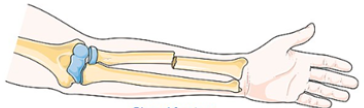 <p>Skin remains intact </p>