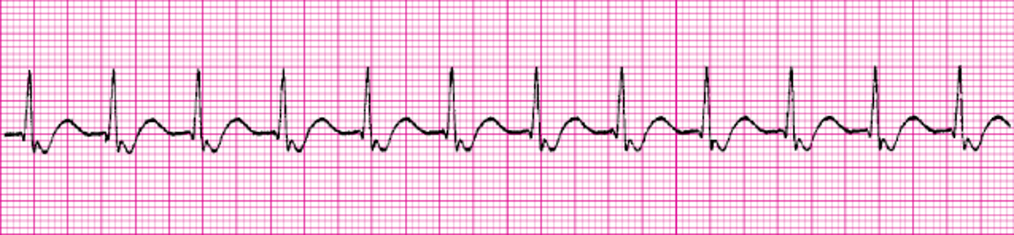 <p>What ECG is this</p>
