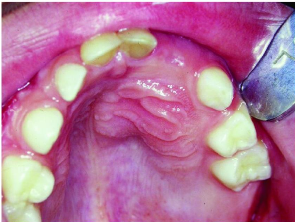 <p>Complain of missing teeth in 5 year old boy. Provide DD</p>