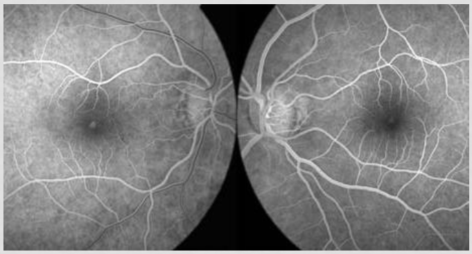 <p>early hyper </p><p>small window defect; loss of RPE/photor, can see through it </p>