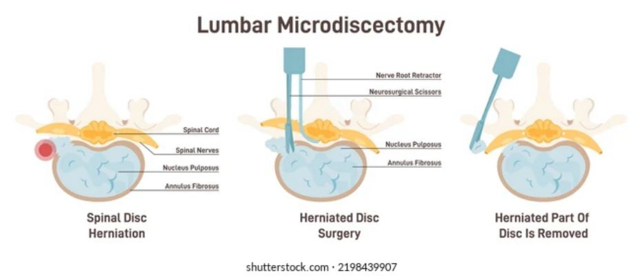 <p>Where portion of the disc is removed</p>