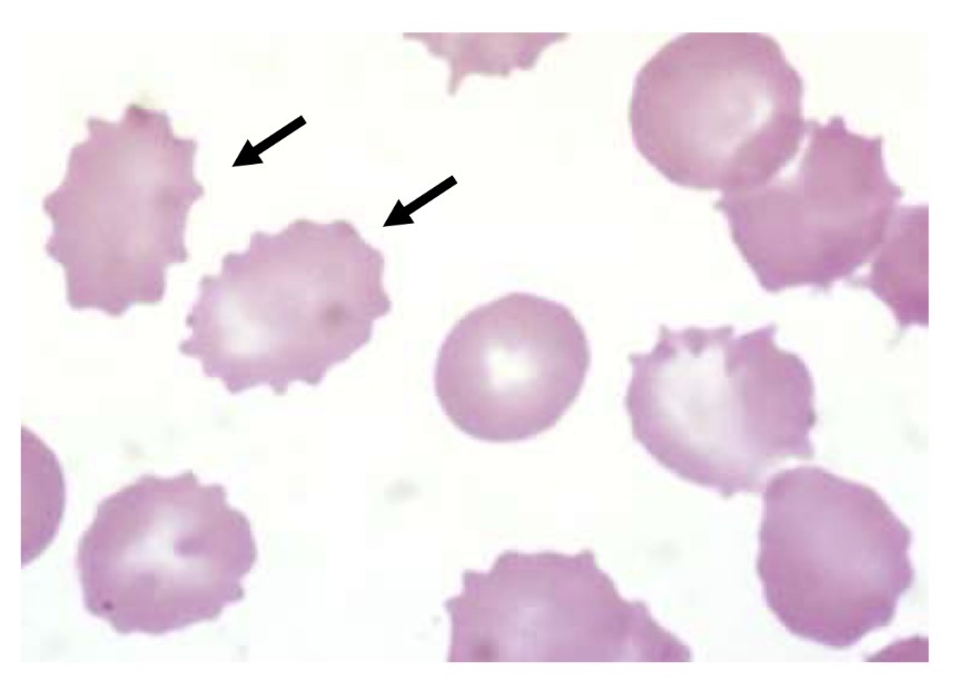 <p>Burr cell or cremated cell, an RBC with blunt, regular spikes</p>