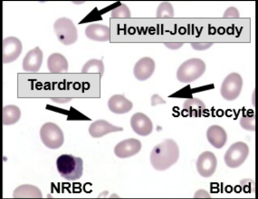 <p>Megaloblastic Anemia</p>