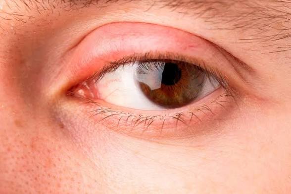 <p>Bulto benigno y generalmente indoloro que se forma en el párpado superior o inferior. Se produce por la obstrucción e inflamación crónica de una glándula sebácea</p>