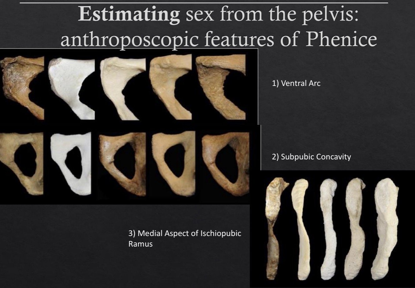 <p><strong><u><span>Phenice Method</span></u></strong><span>: ranking pubic features from 1 to 5 ~90-95% accuracy</span></p><ul><li><p><u><span>Greater Sciatic Notch</span></u><span>: broader in females</span></p></li><li><p><span>﻿﻿</span><u><span>Ventral Arc</span></u><span>: females have a ridge on ventromedial aspect of pubis</span></p></li><li><p><span>﻿﻿</span><u><span>Subpubic Concavity</span></u><span>: "bowing" of inferior pubic border in females</span></p></li><li><p><span>﻿﻿</span><u><span>Medial Aspect of the Ischiopubic Ramus</span></u><span>: females have a sharp border</span></p></li></ul><p></p>