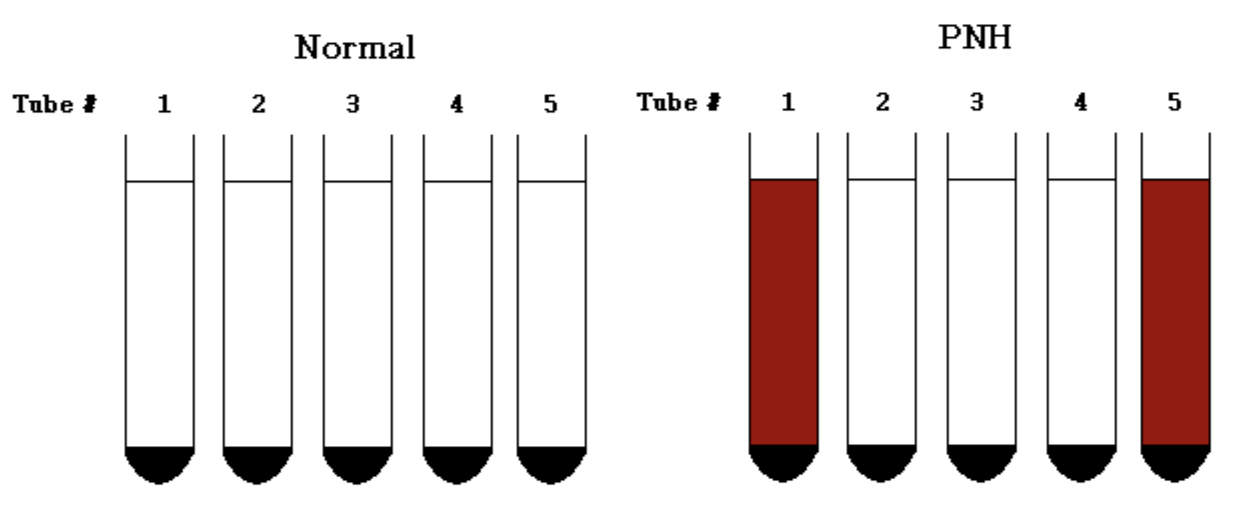 <p><span style="background-color: transparent;">used to diagnose PNH due to the RBCs increased sensitivity to an acid environment. complement will affix to RBCs in a slightly acidic pH from patients with paroxysmal nocturnal hemoglobinuria & will become activated by the alternative pathway and lyse the RBCs. wash patient and control RBCs and make 50% suspension, prepare five tubes, 3 components (RBC – complement – acid), incubate tubes at 37º C for 1 hr, centrifuge & examine for hemolysis. </span></p><p><span style="background-color: transparent;">positive for PNH if tubes 1 and 5 are positive and tubes 2-4 are negative.</span></p>