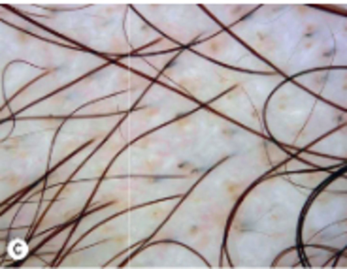 <p>Trichoscopy findings include yellow dots, short vellus hairs, black dots, tapering hairs, and broken hairs</p>