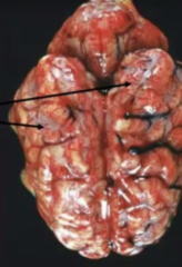 <p>Milky colored lesions like this in the brain expressed in pigs that had CNS signs like paddling before death are evident of what?</p>