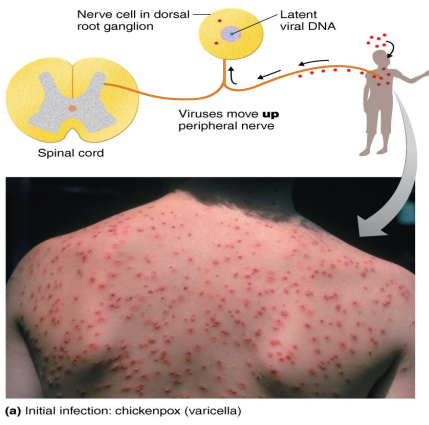<ul><li><p><strong>Pathogen → Herpesvirus varicella-zoster (human herpesvirus 3)</strong></p></li><li><p>Transmitted via the <strong>respiratory route</strong></p></li><li><p><strong>Causes pus-filled vesicles</strong></p></li><li><p>Reye’s syndrome: severe complications of chickenpox; vomiting and brain dysfunction</p><ul><li><p>Aspirin use increases risk</p></li></ul></li><li><p>Virus becomes latent in the central nerve ganglia</p></li><li><p>Prevented by a live attenuated vaccine</p><ul><li><p>Breakthrough varicella can occur if previously vaccinated</p></li></ul></li></ul><p></p>