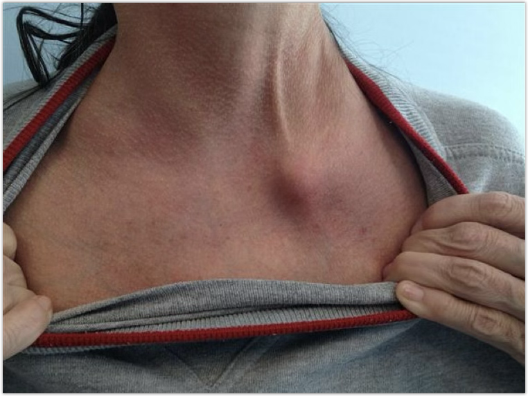 <p>how does a SC sprain occur?</p>