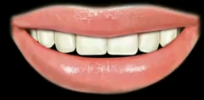<p>A low smile line is when you smile and you don’t see any gums. What % of your anterior teeth are shown?</p>