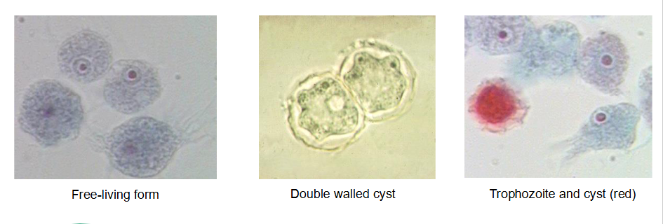 <p>Free living amoeba, causes GAE, contaminated contact lens use. Cyst is doubled walled, troph has central prominent karyosome</p>