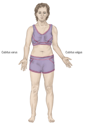<p>cubitis varus- hand closer to body elbow is laterally away from body </p><p></p><p>cubitis valgus- elbow closer to body, hand away from body ( think caryign angle) </p>