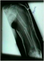<p>Closed, extra-articular, comminuted, transverse, mid-shaft, humeral fracture with mild medial displacement</p>