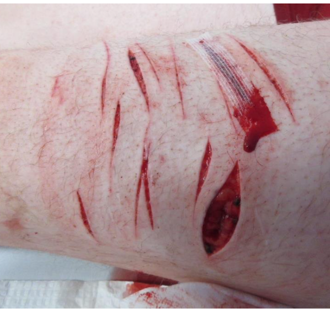 <p><strong>Incised wounds:</strong><br>Wounds caused when a <strong>sharp-edged instrument moved across the body surface</strong>.</p><p class="isSelectedEnd"></p><p class="isSelectedEnd"><strong>Key features:</strong></p><ul><li><p>Caused by <strong>sharp objects</strong> (e.g., knife, glass)</p></li><li><p><strong>Clean, well-defined edges</strong></p></li><li><p><strong>No bridging tissue</strong> present</p></li><li><p><strong>Cut:</strong> incision through skin and underlying soft tissue</p></li><li><p><strong>Slash:</strong> more forceful sweeping cut, often indicating <strong>intent to harm</strong></p></li></ul><p class="isSelectedEnd"></p><p class="isSelectedEnd"><strong>Forensic point:</strong></p><ul><li><p>Shows <strong>sharp force injury</strong>, but usually <strong>does not identify the specific weapon used</strong>.</p></li></ul><p></p>