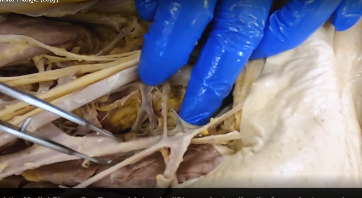 <p>deep in the femoral triangle. will drive between pectineus and iliopsoas muscles</p>