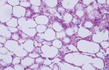 <ol><li><p>Sickle Cell Anemia</p></li><li><p>Atherosclerosis</p></li><li><p>Adenocarcinoma of Kidney</p></li><li><p>Osteogenic Sarcoma of Bone</p></li><li><p>Tattoo in Human Skin</p></li><li><p>Neurilemmoma</p></li><li><p>Anthracosis of the Lung</p></li><li><p>Basal Cell Carcinoma</p></li><li><p>Lung</p></li><li><p>Skeletal</p></li><li><p>Kidney</p></li><li><p>Neuron</p></li><li><p>Skin</p></li><li><p>Blood</p></li><li><p>Bone</p></li><li><p>Aorta</p></li></ol><p></p>