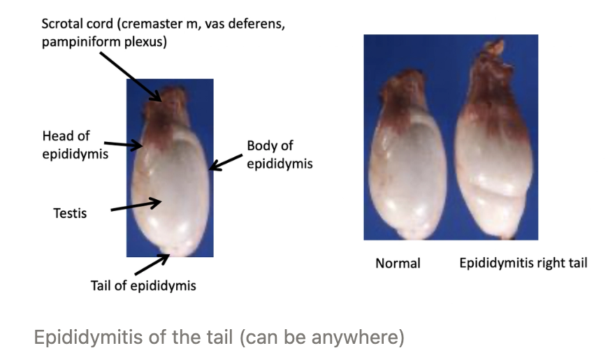 <ol><li><p>Disruption of tubular epithelium by pathogen</p></li><li><p>Inflammatory reaction causes leakage of sperm into interstitium</p></li><li><p>Sperm outside the testes = Foreign body reaction (haploid cells)</p></li><li><p>Chronic granulomatous inflammation with fibrosis → Obstructed tubules</p></li><li><p>2˚ testicular atrophy (orchitis rare)</p></li></ol><p></p>