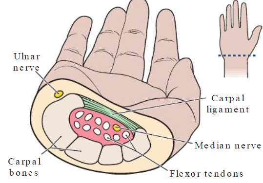 <p><strong>Definition</strong></p><ul><li><p>Compression of median nerve in carpal tunnel of wrist</p></li></ul><p></p><p><strong>Causes</strong></p><ul><li><p>Poor posture, repeatedly bending hands (up, down, side to side), pinch gripping w/o rest</p></li></ul><p></p><p><strong>Symptoms</strong></p><ul><li><p>Numbness, pain, tingling in thumb, index, middle fingers</p></li></ul><p></p>
