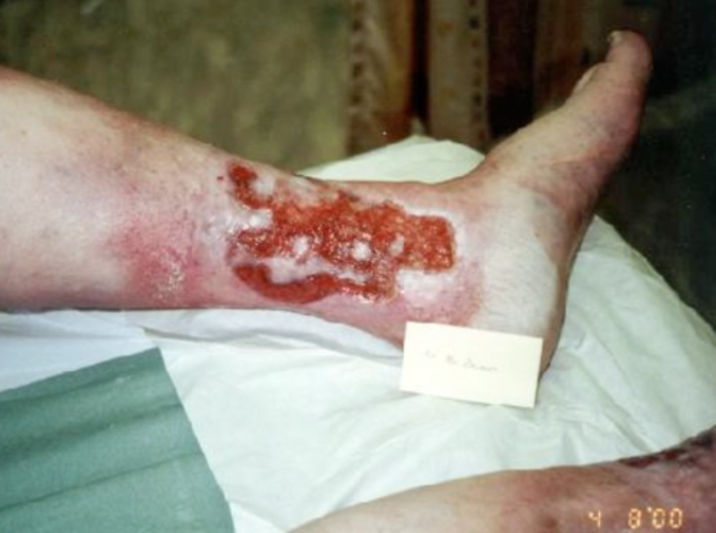 <p>chronic venous stasis</p><p>preceded by stasis dermatitis</p><p>lower extremities</p><p>wide but superficial</p>