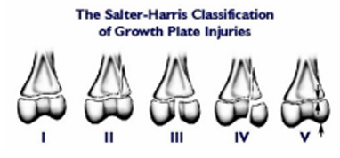<p>o Type 1: separation of physis   </p><p>o Type 2: separation of growth plate &amp; small </p><p>part of   </p><p>metaphysis   </p><p>o Type 3: fracture of physis   </p><p>o Type 4: fracture of portion of physis &amp; </p><p>metaphysis   </p><p>o Type 5: crushing force (growth deformity)</p>