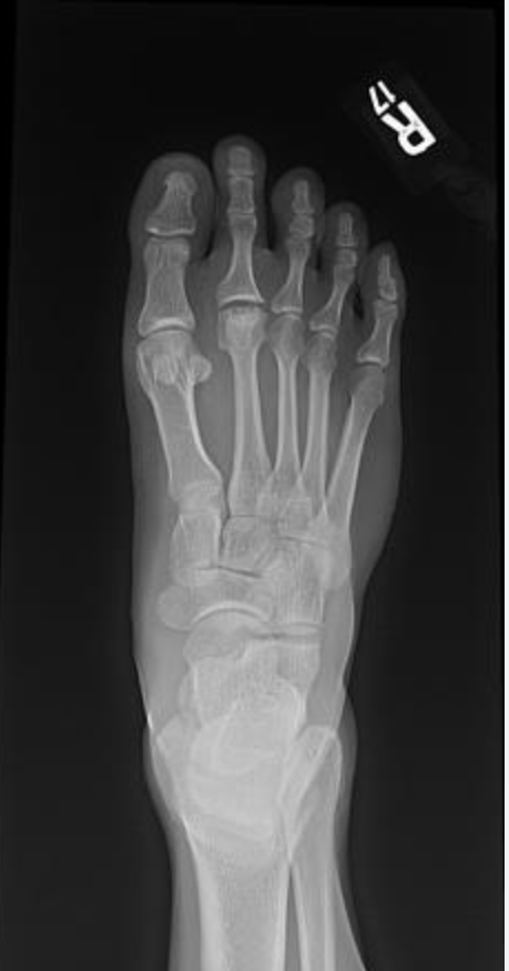 <p>AVN of the head of the 2nd or 3rd metatarsal </p>