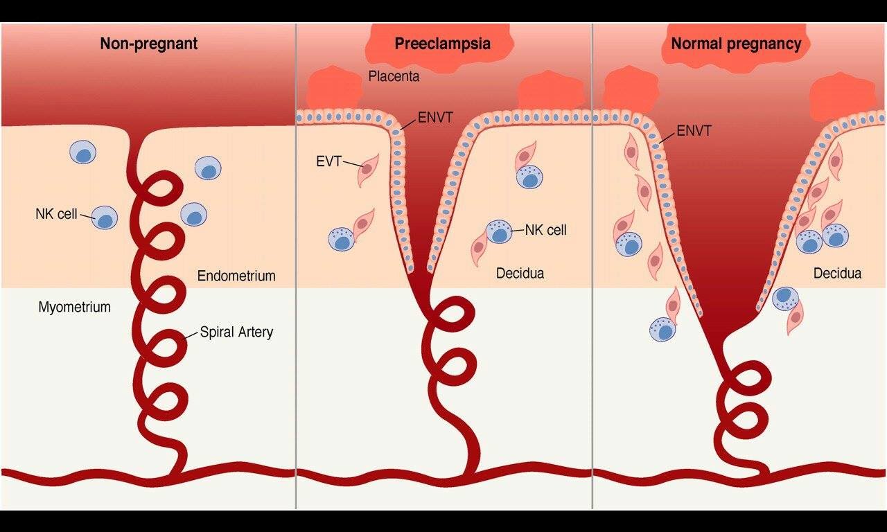 <p>eclampsia</p>