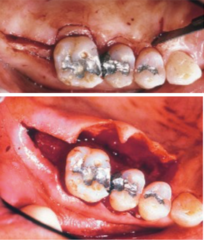 <p>To reduce periodontal pockets in retromolar areas and edentulous areas adjacent to teeth, used for crown lengthening, and as extensions of palatal/buccal flap incisions.</p><p>(Explanation: The distal wedge targets deep pockets in areas like the retromolar pad or edentulous ridges, where access is challenging. It's also used in crown lengthening to expose more tooth structure for restorative purposes, often integrated with flap surgeries to enhance access and outcomes.)</p>