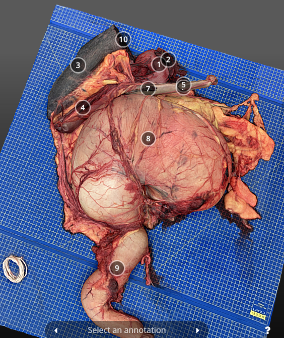 <p>Describe this SI herniation</p>