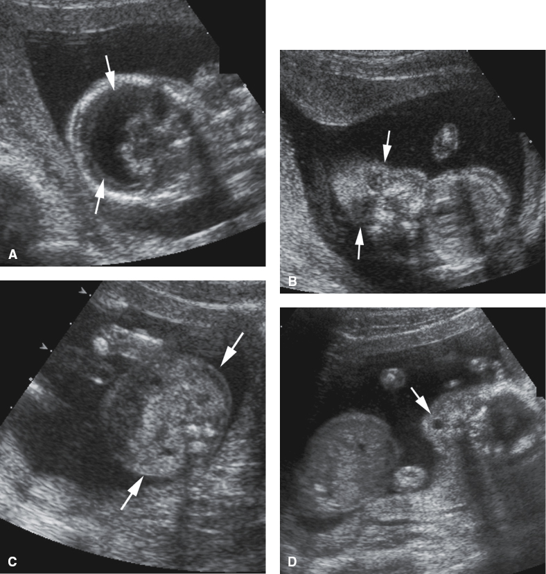 <p>Horseshoe-shaped monoventricle</p><p>Fused echogenic thalami</p><p>Absence of the CSP, interhemispheric fissure, falx cerebri, corpus callosum, and third ventricle</p><p>Normal cerebellum and brainstem</p><p>Facial anomalies (e.g., cyclopia, proboscis, cebocephaly, facial clefts, hypotelorism)</p>