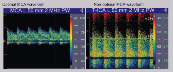 <ul><li><p><span style="background-color: transparent;"><span>Large sample volume creates spectral broadening in all waveforms</span></span></p></li><li><p><span style="background-color: transparent;"><span>All vessels have low resistance w/ relatively high diastolic flow</span></span></p><ul><li><p><span style="background-color: transparent;"><span>Except for OA - it has high resistance</span></span></p></li></ul></li></ul><p></p>