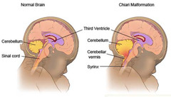 <p>Herniation of low-lying cerebellar vermis and tonsils through foramen magnum. Causes hydrocephalus / ventriculomegaly. Associated with lumbosacral meningomyelocele.</p>